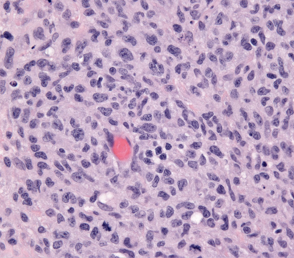 Fig. 10. Inflamed NECTCL. Vasocentric lympho-histiocytic infiltrate mimics CH.