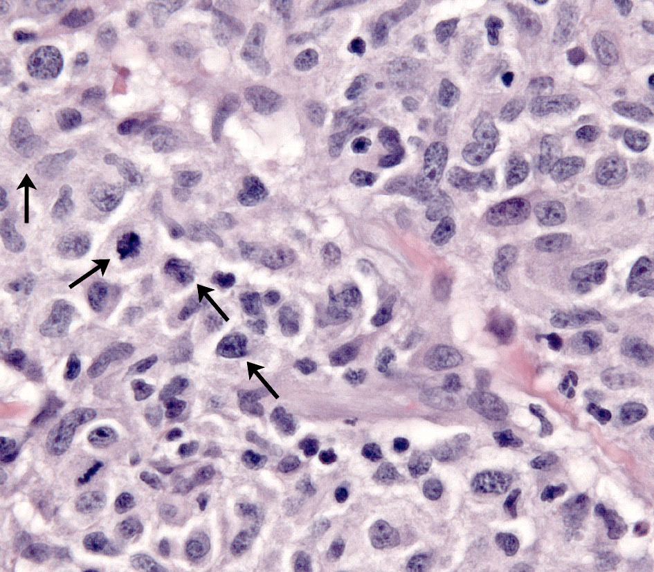 Fig. 11. Inflamed NECTCL. Vasocentric lympho-histiocytic infiltrate - closer inspection reveals large atypical lymphocytes in small clusters (angled arrows) admixed with histiocytes (vertical arrow).