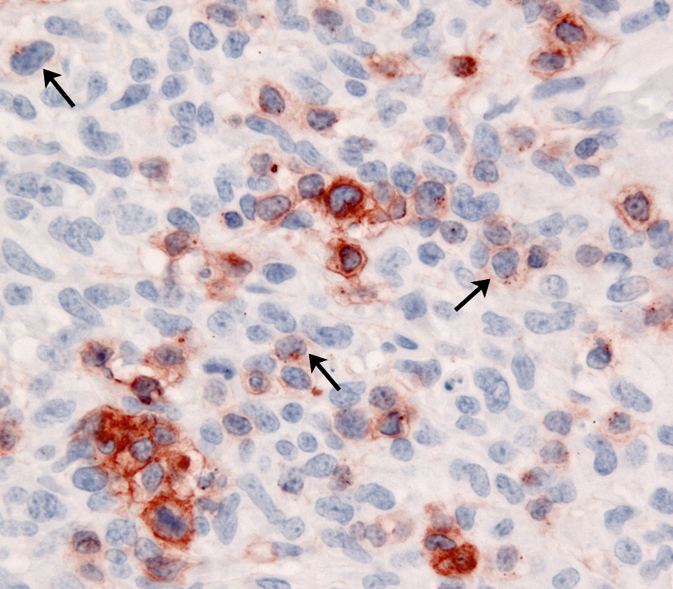 Fig. 12. Inflamed NECTCL. CD3 immunostain. Neoplastic T cells express CD3 with some evidence of diminished CD3 expression (arrows). 
