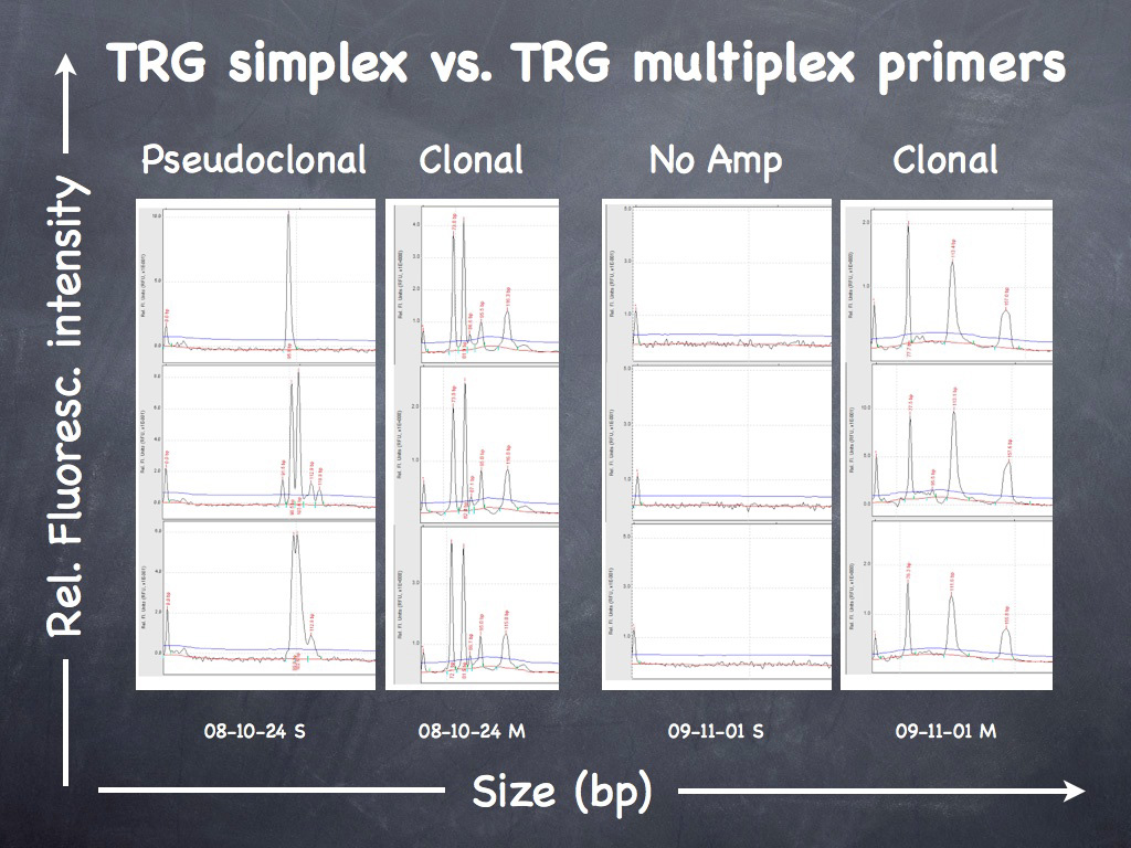 Fig. 13. Inflamed NECTCL. Molecular clonality - TRG (T cell receptor gamma locus) - clonal result in triplicate.