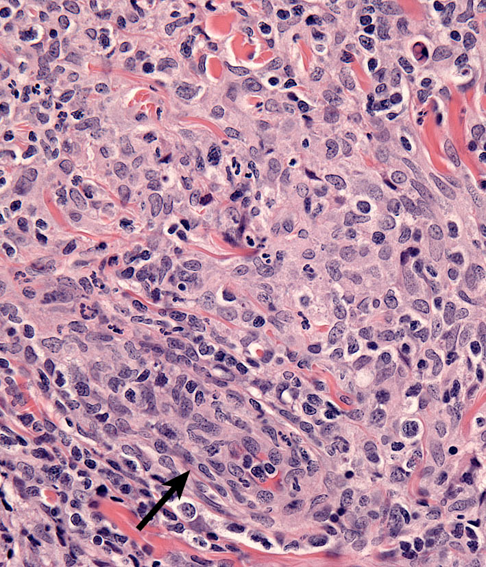 Fig. 5. Cutaneous histiocytosis. Skin. Vasocentric lesion with perivascular histiocytic infiltrate. Vessel wall infiltration by histiocytes and fewer lymphocytes (arrow).