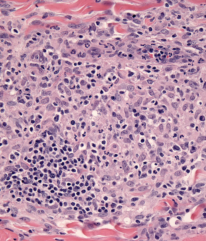 Fig. 6. Cutaneous histiocytosis. Skin. Vasocentric lesion with perivascular histiocytic infiltrate and focal intense lymphocytic infiltrate.