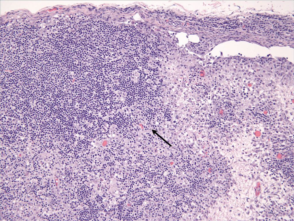 Fig. 7. Cutaneous histiocytosis - Lymph node. paracortical histiocytic infiltrate (arrow).