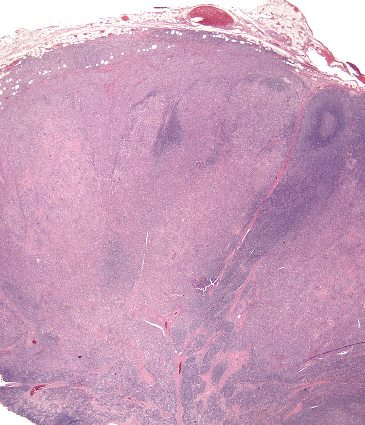 Fig. 8. Cutaneous histiocytosis - Lymph node. Effacement of trabeculae, capsule and parenchyma by a histiocytic infiltrate. 