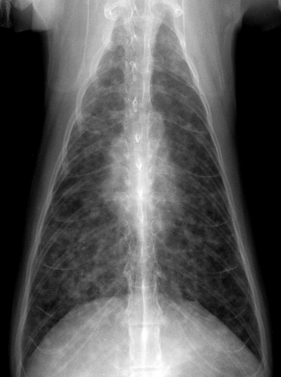 Fig. 1. pLCH - Thorax - Severe, diffuse broncho-interstitial infiltrative pattern throughout all lung lobes. 