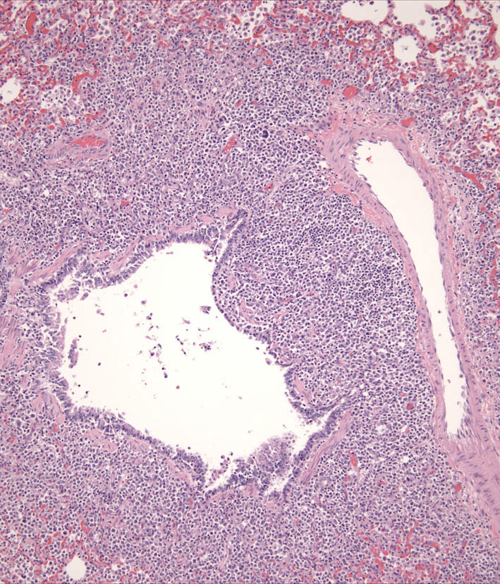 Fig. 10. Peribronchial infiltrate in metastatic cLCH