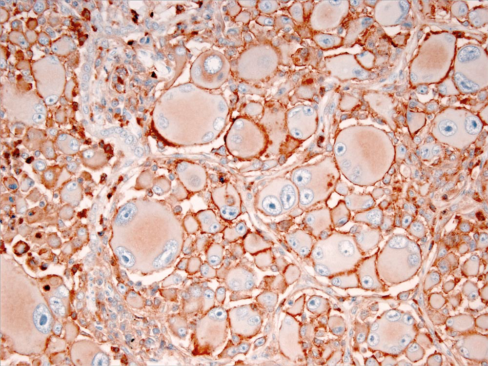 Fig. 3. Pulmonary HS: prominent CD18 expression by neoplastic cells - delicate membranous and cytoplasmic staining