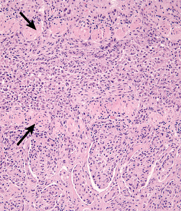 Fig. 3. pLCH - Lung - Histiocytes form cohesive sheets, which fill a respiratory bronchiole (arrow - wall) and extend peribronchially.