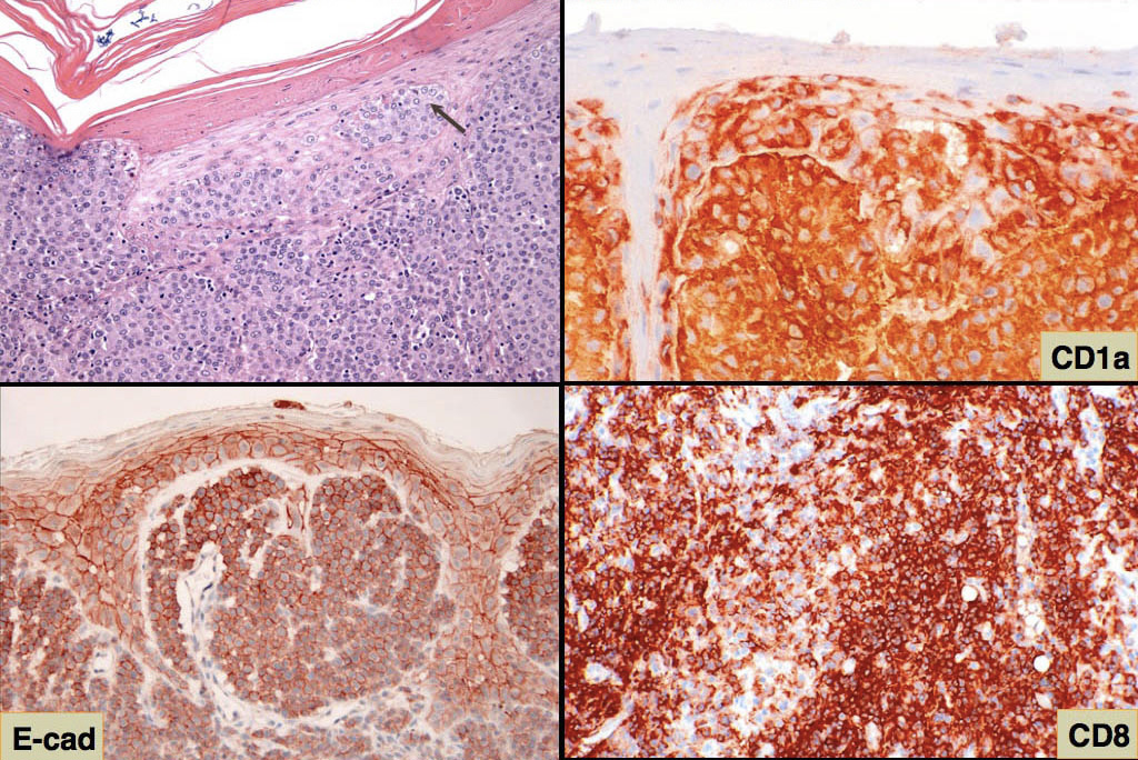 Fig. 4. HE stain: epidermal nests in histiocytoma; CD1a expression in histiocytoma;  E-cadherin expression by keratinocytes and histiocytoma cells; CD8 expressing cytotoxic T cells in regressing histiocytoma