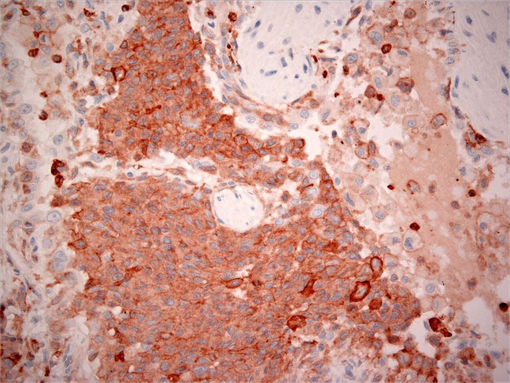 Fig. 5. pLCH - Histiocytes express CD18