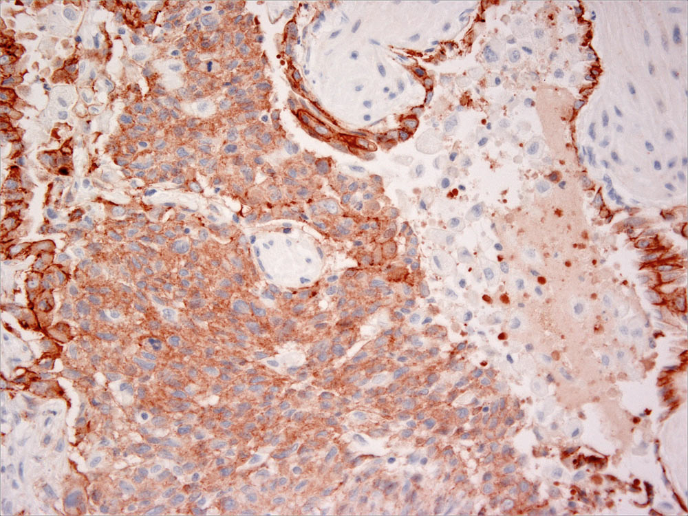 Fig. 6. pLCH - Histiocytes express E-cadherin 