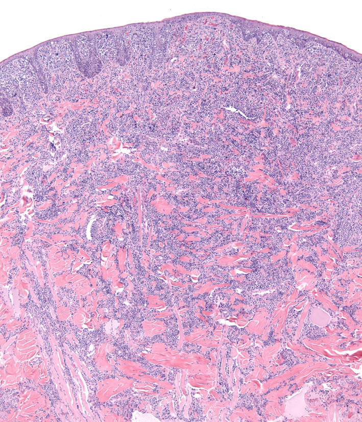 Fig. 7. Topography of cLCH with epidermal tropism