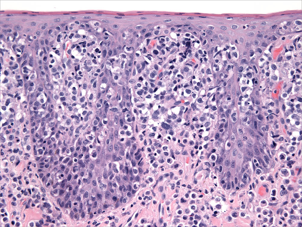Fig. 8. Intra-epidermal nests in cLCH