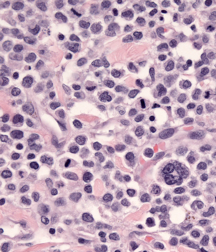 Fig. 9. Multinucleated histiocyte in cLCH