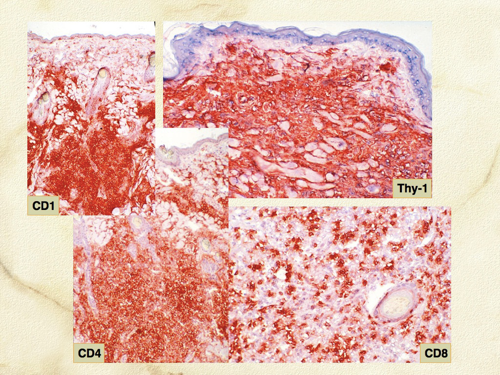 Fig. 9. Cutaneous histiocytosis - Skin. Frozen section immunostaining. Histiocytes are CD1a+CD4+CD90+ (Thy-1 = CD90). 